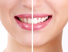 teeth whitening perth